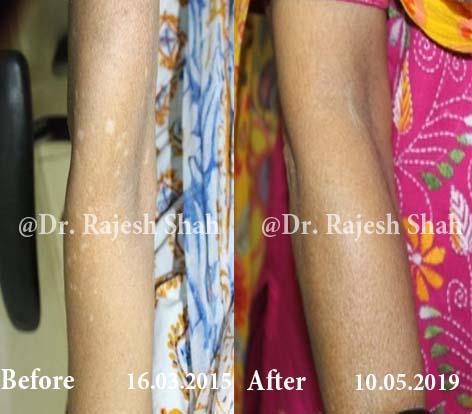 Vitiligo Before and After Case Photo