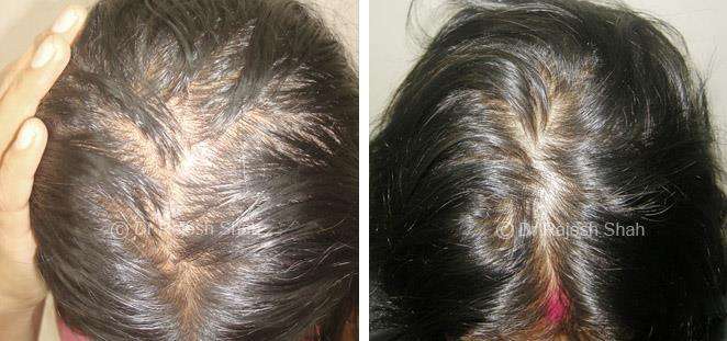 Hair loss Before and After Case Photo