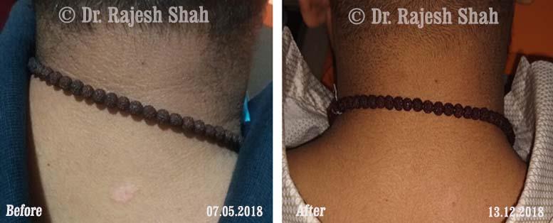 Psoriasis Before and After Case Photo