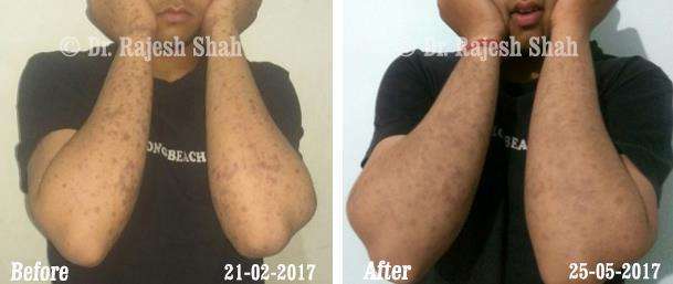Lichen Planus Before and After Case Photo