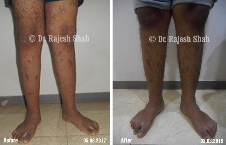 Psoriasis Before and After Case Photo