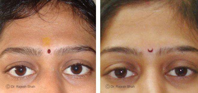 Alopecia Areata Before and After Case Photo