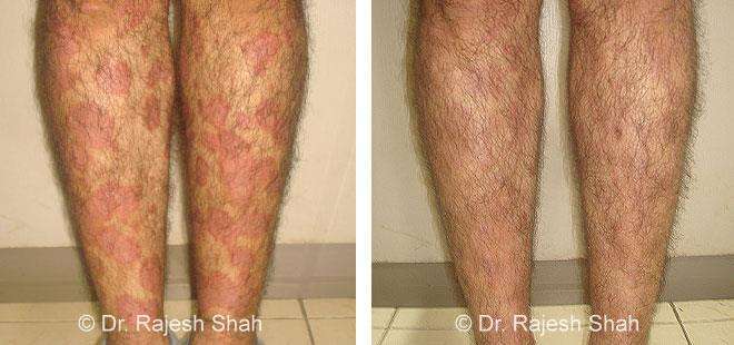 Psoriasis Before and After Case Photo