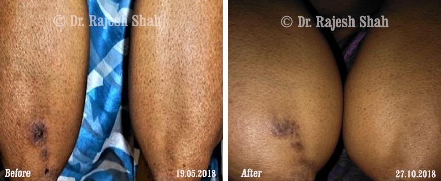 Psoriasis Before and After Case Photo