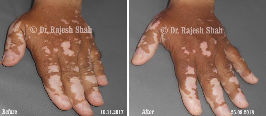 Vitiligo Before and After Case Photo