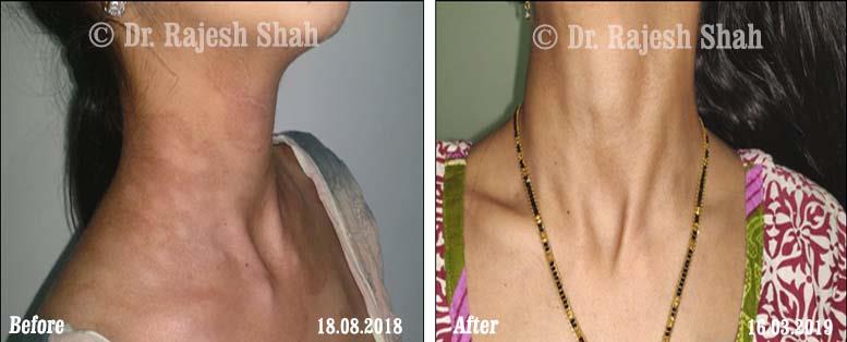 Psoriasis Before and After Case Photo