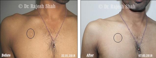 Vitiligo Before and After Case Photo