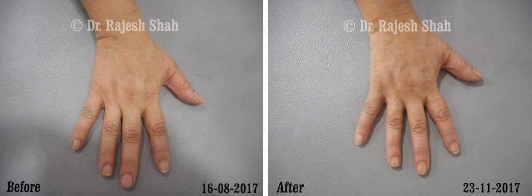 Lichen Planus Before and After Case Photo