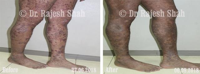 Psoriasis Before and After Case Photo