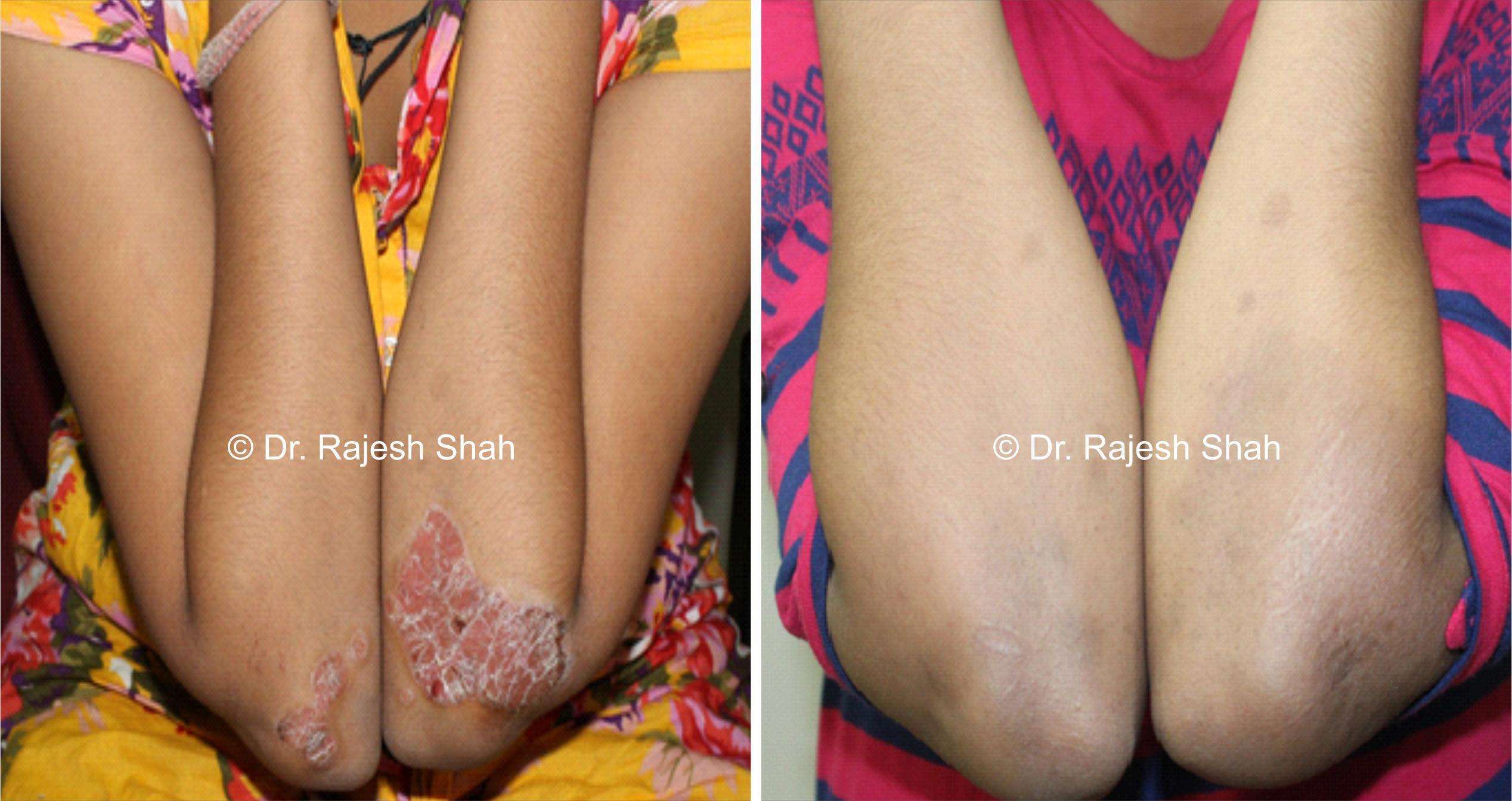 Psoriasis Before and After Case Photo