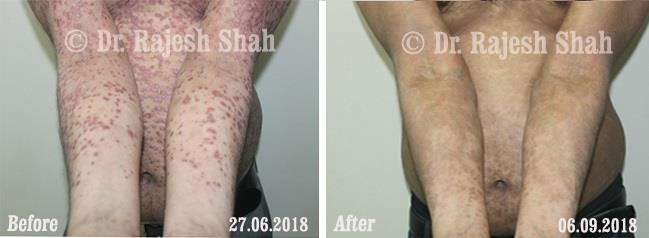 Psoriasis Before and After Case Photo