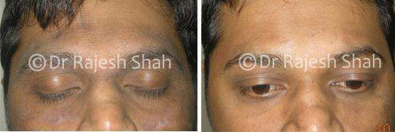 Eczema Before and After Case Photo