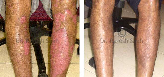 Psoriasis Before and After Case Photo