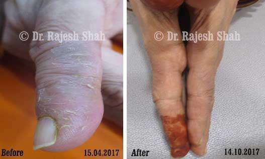 Psoriasis Before and After Case Photo