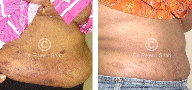 Lichen Planus Before and After Case Photo