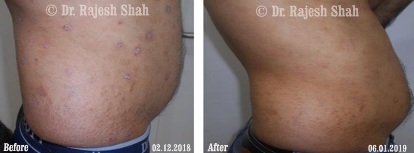 Psoriasis Before and After Case Photo