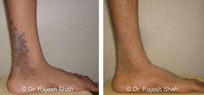 Lichen Planus Before and After Case Photo