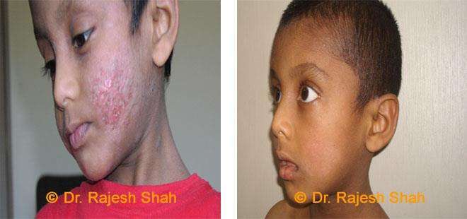 Eczema Before and After Case Photo