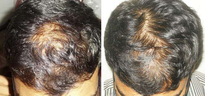 Alopecia Areata Before and After Case Photo
