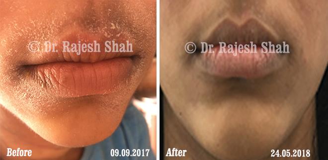 Eczema Before and After Case Photo