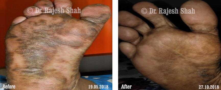 Psoriasis Before and After Case Photo