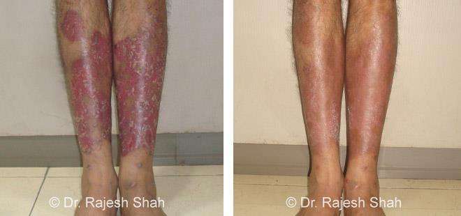 Psoriasis Before and After Case Photo