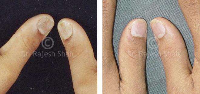 Psoriasis Before and After Case Photo