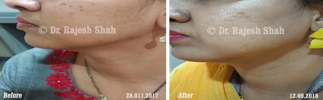 Acne Before and After Case Photo