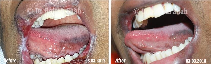 Lichen Planus Before and After Case Photo