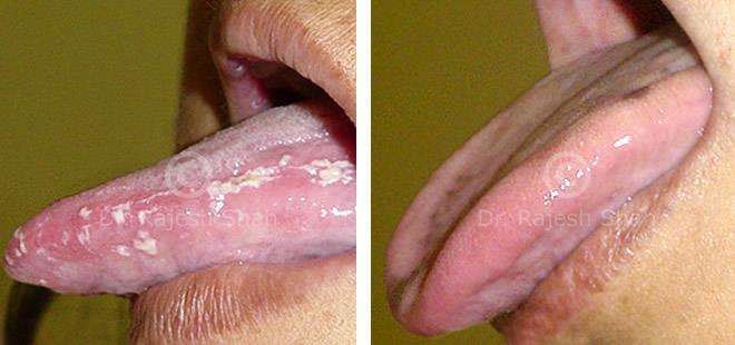 Lichen Planus Before and After Case Photo