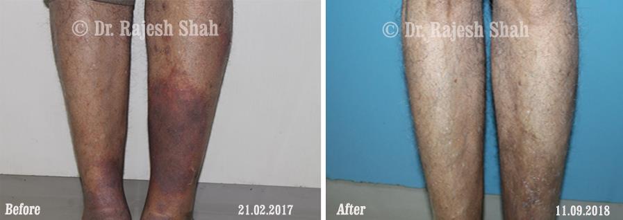 Eczema Before and After Case Photo