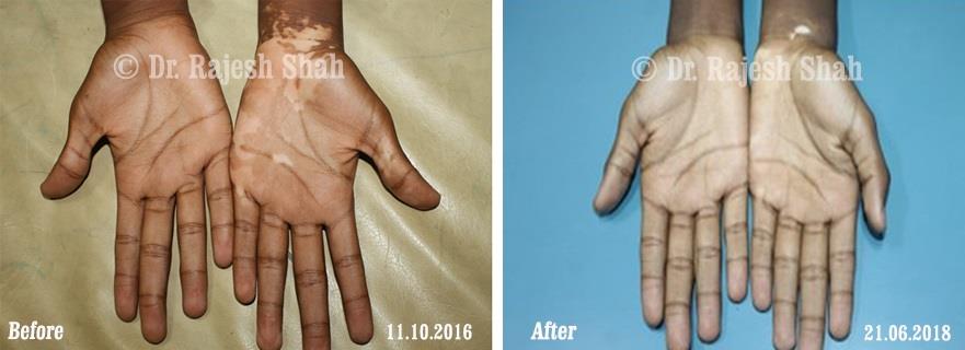 Vitiligo Before and After Case Photo
