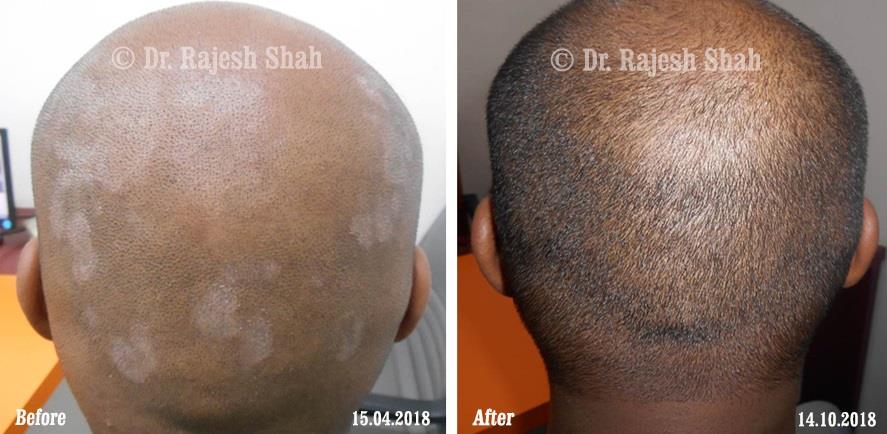Lichen Planopilaris Before and After Case Photo