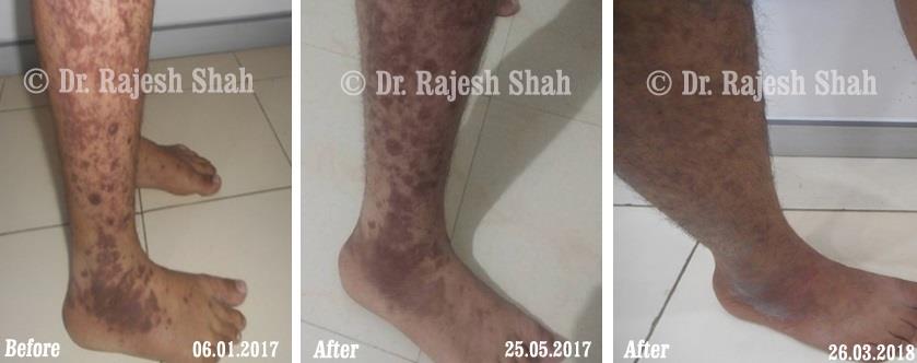 Lichen Planus Before and After Case Photo
