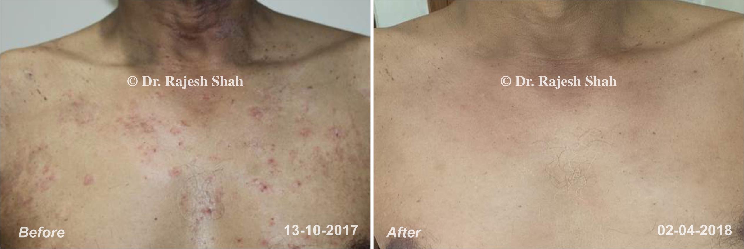Psoriasis Before and After Case Photo