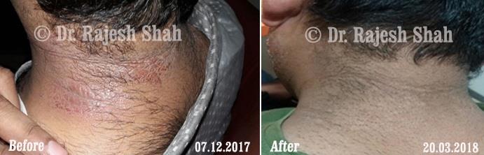 Psoriasis Before and After Case Photo