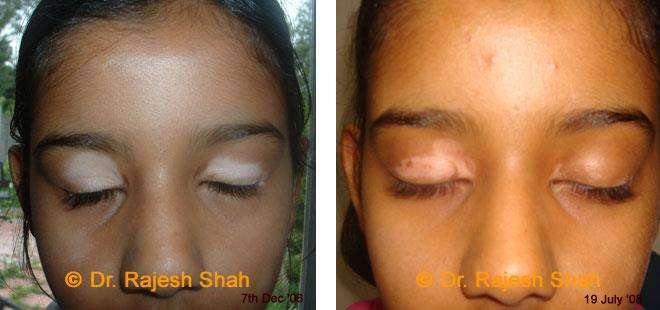 Vitiligo Before and After Case Photo