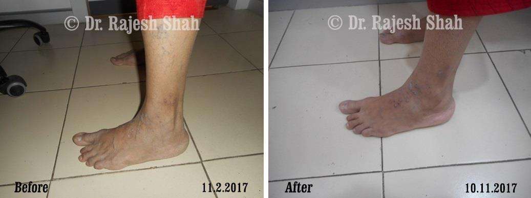 Psoriasis Before and After Case Photo