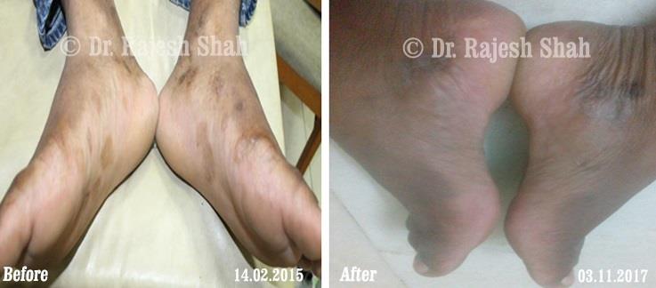 Psoriasis Before and After Case Photo