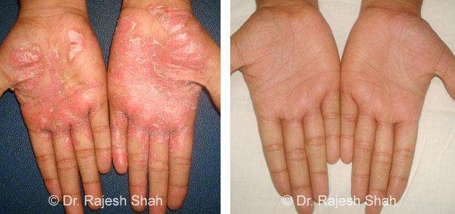Psoriasis Before and After Case Photo