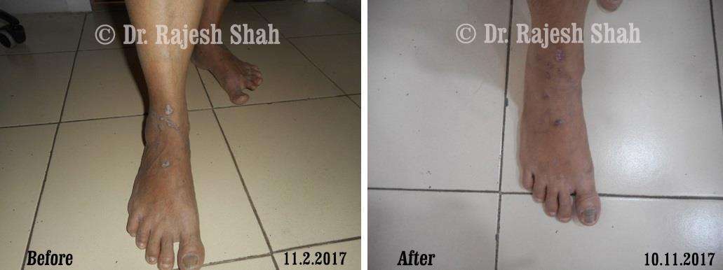 Psoriasis Before and After Case Photo