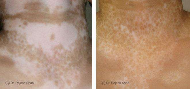 Vitiligo Before and After Case Photo