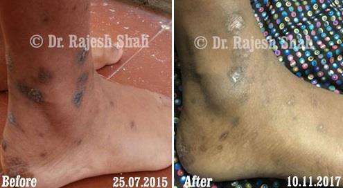 Lichen Planus Before and After Case Photo