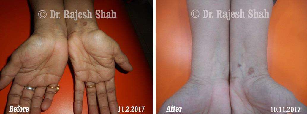 Psoriasis Before and After Case Photo