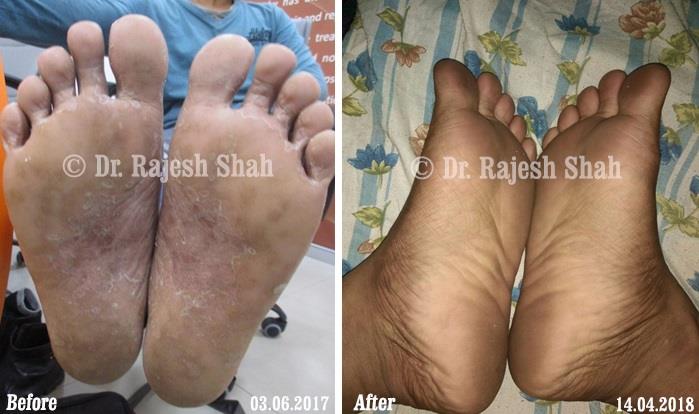 Psoriasis Before and After Case Photo