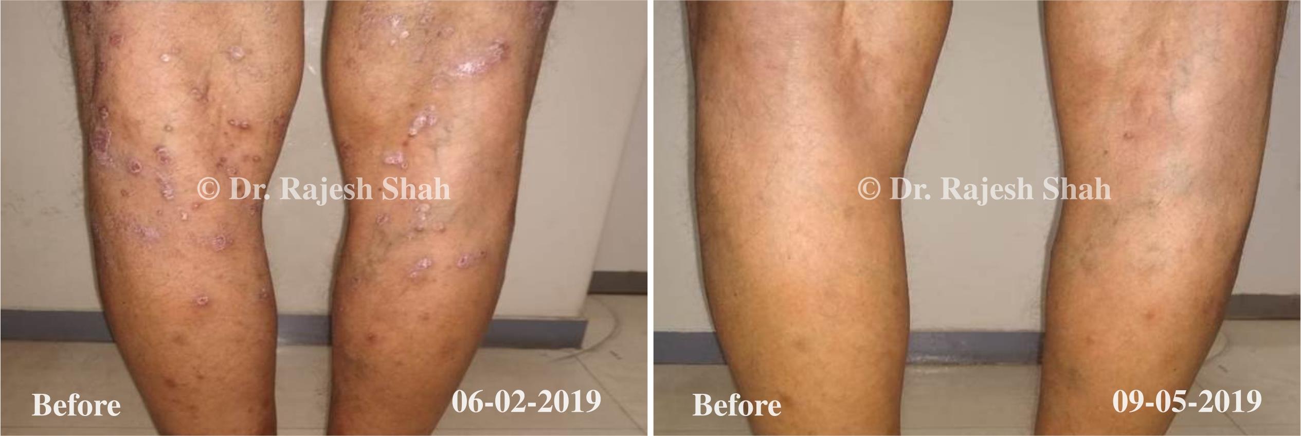 Psoriasis Before and After Case Photo