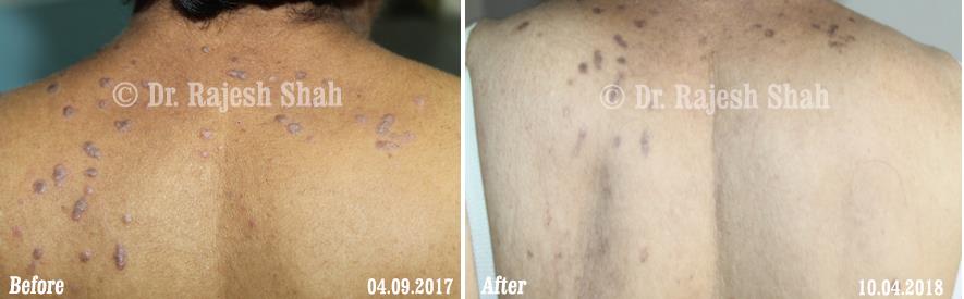 Lichen Planus Before and After Case Photo