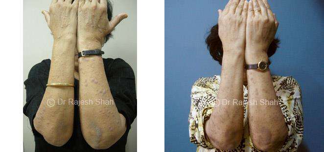 Lichen Planus Before and After Case Photo