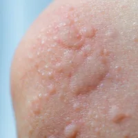 Acute urticaria sudden hives