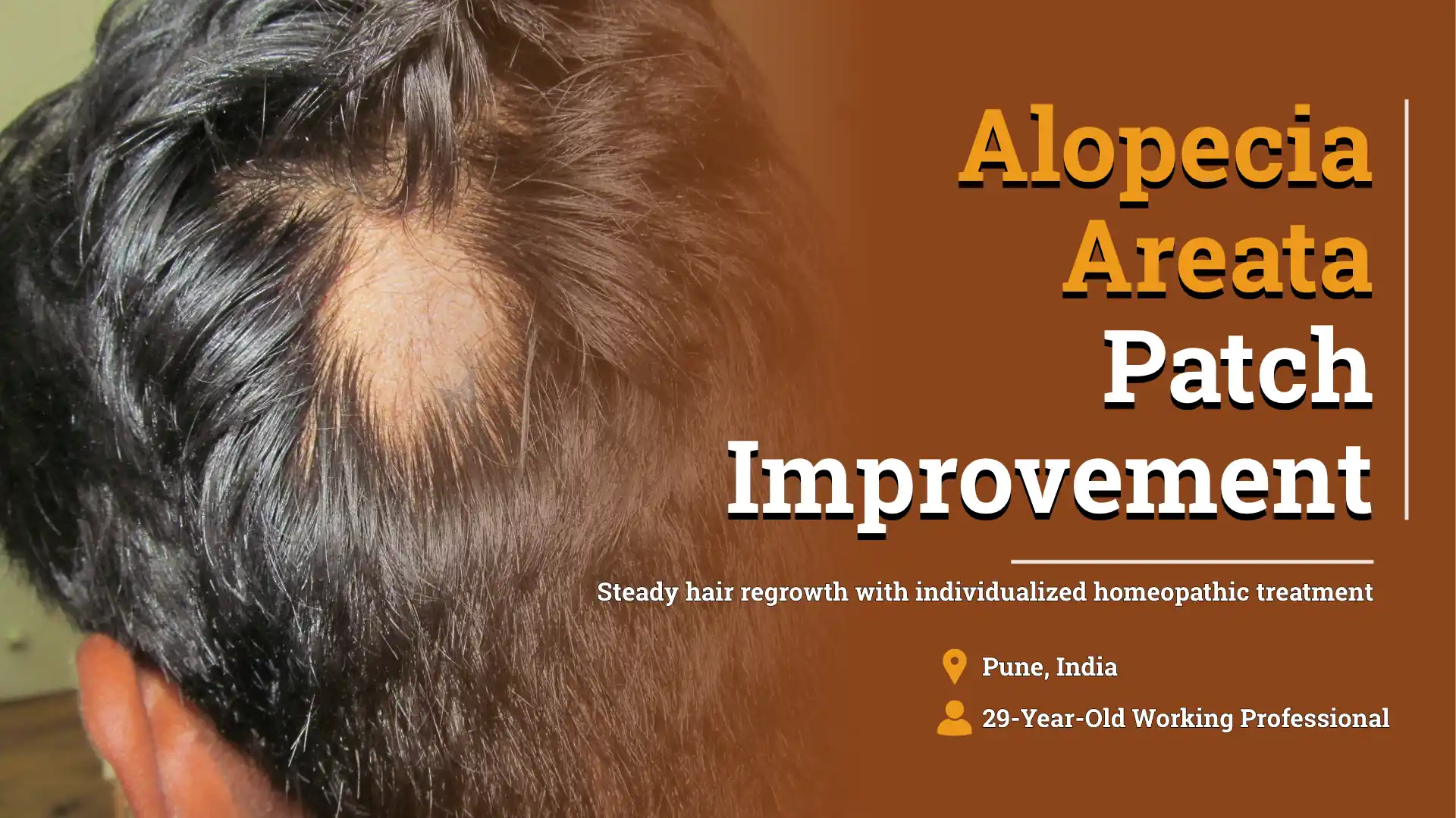 Before and after improvement of an alopecia areata scalp patch in a 29-year-old male treated with individualized homeopathic treatment at Life Force Homeopathy under Dr. Rajesh Shah.